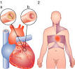 <b>angina pectoris</b>