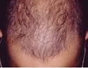 شایعترین عامل ریزش مو چیست؟