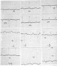 <b>Hipertrofia Ventriculo Direito</b> | Atendimentos Particulares