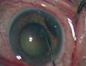 Review of Ophthalmology® > Viscoelastic Solutions to Challenging ...