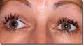 <b>anisocoria</b>_4.jpg