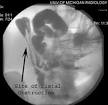 <b>Gardner's syndrome</b>