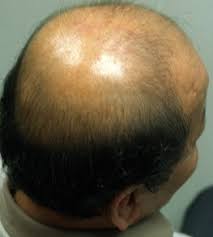  ubat rambut gugur rawatan rambut botak masalah rambut gugur masalah rambut botak 
