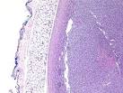 <b>mesoblastic nephroma</b>