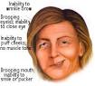Bell's Palsy Treatment & Surgery Information - Bell's Palsy ...