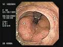 Sessile Villous <b>Adenoma</b>.