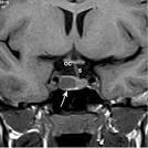 pointing to <b>prolactinoma</b>