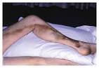 Superficial <b>Thrombophlebitis</b>