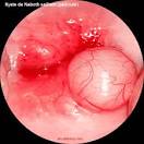<b>kyste</b> de Naboth ou <b>kyste</b> glandulaire par rétention au niveau du