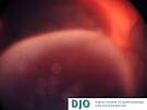 DJO | Digital Journal of Ophthalmology