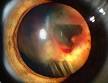 <b>Retinal detachment</b> - Wikipedia, the free encyclopedia