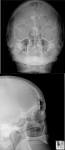 in <b>Gardner's syndrome</b>