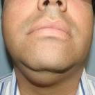 of the <b>Sublingual Gland</b>