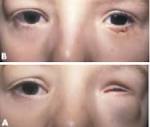 congenital <b>microphthalmos</b>