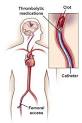<b>Thrombolytic Therapy</b> India