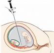 <b>Fetoscopy</b> is definitely an