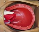 <b>Retained Placenta</b>