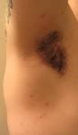 Red bumps in and around armpits, have pics to show