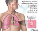 <b>Tuberculosis</b> of the lungs