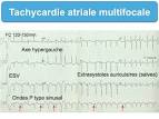 <b>Tachycardie atriale</b>