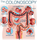 <b>Colonoscopies</b> are one of the