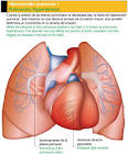 <b>Hipertensión pulmonar</b>