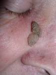 File:<b>Papilloma</b> skin.jpg - Wikimedia Commons