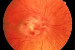 photograph-CMV <b>retinitis</b>