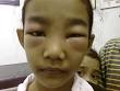 Nephrotic Syndrome | e-Didik. e-Learning. e-