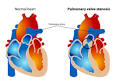 de la <b>válvula pulmonar</b> o