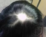 found that <b>alopecia</b> areata