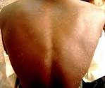 <b>Tinea versicolor</b> (courtesy of