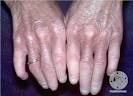 diagnosis: <b>CREST Syndrome</b>
