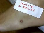 File:<b>Foreign body granuloma</b>.