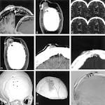 with <b>sinus pericranii</b> and