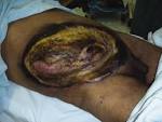 Photos related to <b>Fournier's Gangrene</b>