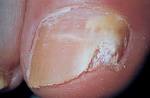 <b>Onychomycosis</b> in AIDS, with