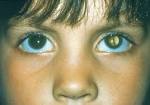 to a congenital <b>cataract</b>.