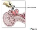 through the <b>laryngoscope</b>,