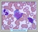 <b>MONONUCLEOSIS INFECCIOSa</b>