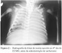 da complacência pulmonar,