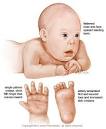 Down Syndrome | Nursing Crib