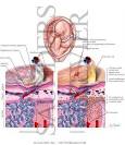<b>Chorioamnionitis</b> - Netter Medical Artwork