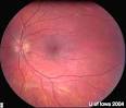 <b>Kearns</b>-<b>Sayre Syndrome</b>