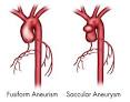 Types of Aortic Aneurysms