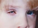 Congenital <b>Microphthalmos</b>