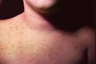 <b>aseptic meningitis</b>,