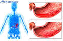 <b>Hematemesis</b> or Vomiting of