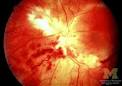Cytomegalovirus <b>retinitis</b>