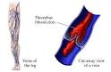 <b>Thrombophlebitis</b>